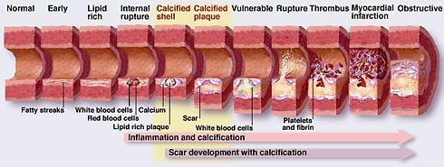 Clean blocked arteries using Fast Acting Liquid Oral Chelation