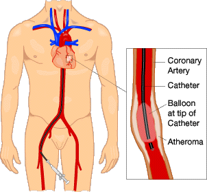 Angioprim is a safe way to reduce Arterial plaque in your arteries and veins.